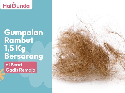 Gumpalan Rambut 1,5 Kg Bersarang di Perut Gadis Remaja