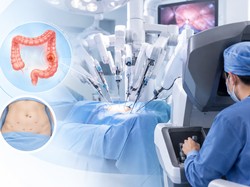 Kanker Usus Besar Bisa Dioperasi dengan Robotik, Kapan Metode Ini Dipilih?