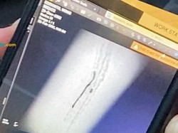 Penampakan Kawat Tertinggal di Jantung Pasien, RS Diminta Tanggung Jawab