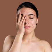 Bekas Jerawat Menghitam dan Susah Hilang? Ini Cara Mengatasi PIH