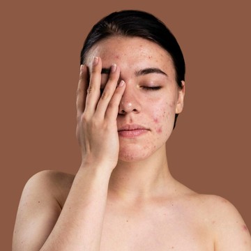 Bekas Jerawat Menghitam dan Susah Hilang? Ini Cara Mengatasi PIH