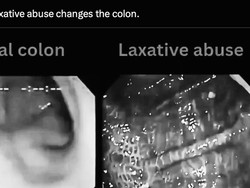 Viral Usus Bermotif Kulit Macan Efek Laxative Abuse, Dokter Pencernaan Angkat Bicara