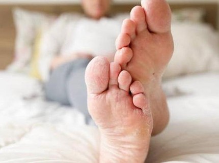 Kenali Tanda Kanker Serviks dari Telapak Kaki