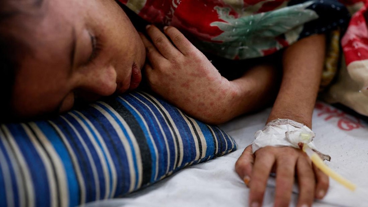 Wabah Campak Menewaskan Ratusan Bocah di Bangladesh