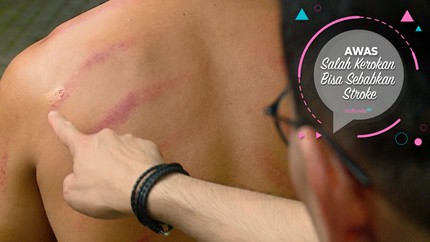 Awas, Salah Kerokan Bisa Sebabkan Stroke